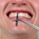 ایمپلنتولوژیست یا دندانپزشک عمومی