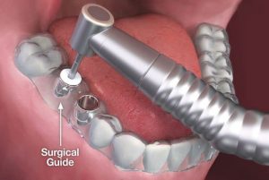نمونه ای از surgical guid | guided surgery