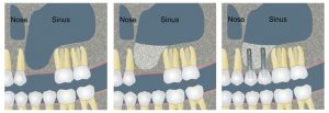 ایمپلنت دندان و درد سینوس
