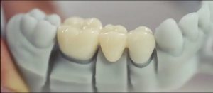 پرینت سه بعدی دندانپزشکی