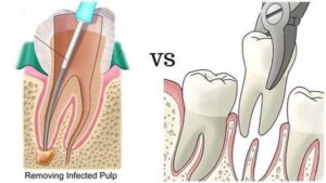 کشیدن دندان یا درمان ریشه