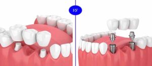 بریج دندان یا ایمپلنت دندان