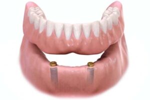 ایمپلنت های دندان |ایمپلنت متحرک