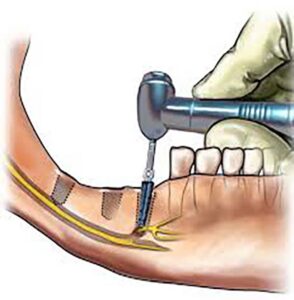 آسیب عصب دندان و ایمپلنت دندان