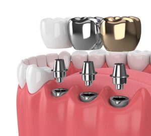 نوع سیستم ایمپلنت دندان