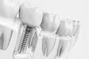 چندتا ایمپلنت دندان