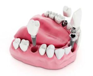 ایمپلنت دندان درد دارد؟
