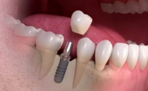 جایگزینی ایمپلنت های دندان