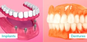 پروتزهای دائمی یا ایمپلنت های دندان
