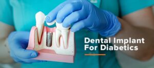 ایمپلنت های دندانی برای بیماران دیابتی 