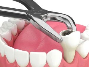 عوارض بعد از کشیدن دندان