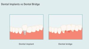 بریج دندان چه فرقی با ایمپلنت دندان دارد؟