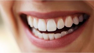 بازسازی کامل دهان و دندان یا Full Mouth Reconstruction چیست؟