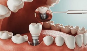 علت خونریزی لثه ها بعد از ایمپلنت دندان چیست؟