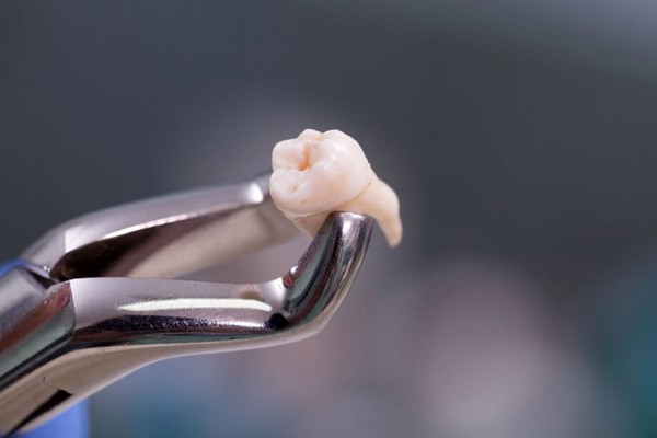 کشیدن اورژانسی دندان عقل چیست؟
