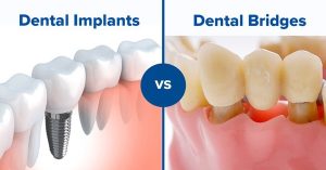 ایمپلنت دندان بهترین گزینه جایگزینی دندان در دسترس است.