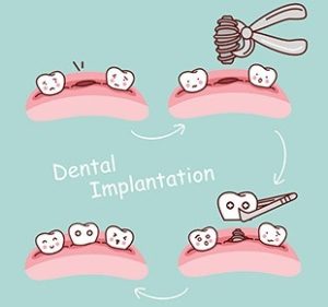 کاشت دندان چطور صورت می گیرد؟