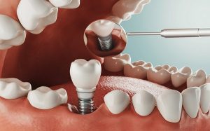 سه راه برای داشتن دندان های خوب پس از عمل دنتال ایمپلنت
