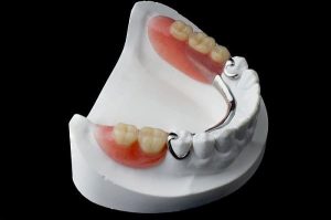 مزایا و معایب پروتز دندان