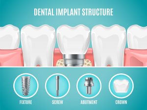 شکستن dental implantها