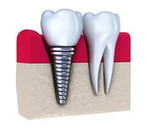 از دست دادن دندان ها چه اثرات منفی خواهد داشت؟