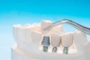 ایمپلنت‌های دندان