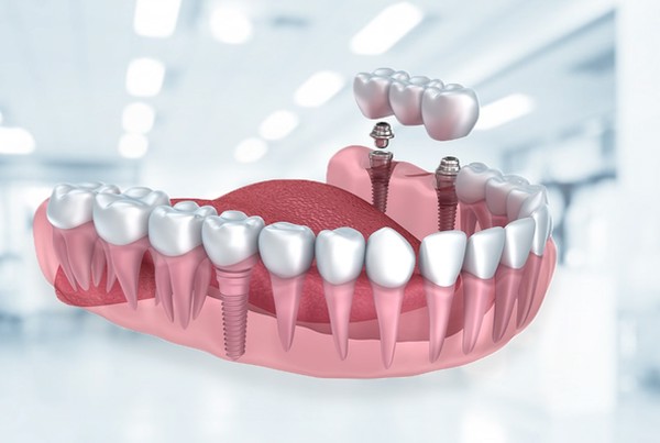 تعداد ویزیت های مورد نیاز برای گذاشتن دندان مصنوعی