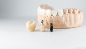 تعداد ویزیت های مورد نیاز برای گذاشتن دندان مصنوعی