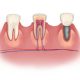 بهبودی از ایمپلنت دندان چگونه است؟