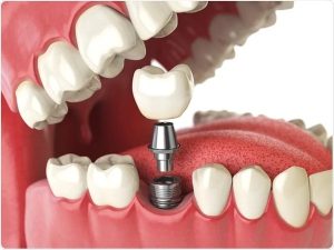 ایمپلنت های تک دندانی چگونه کار می کنند؟